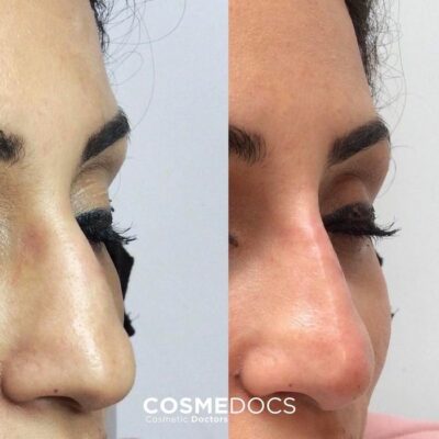 Nose job before and after photos, showcasing refined nasal contours.
