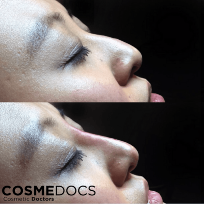 Before and after images of an Asian nose job, displaying significant cosmetic enhancement.