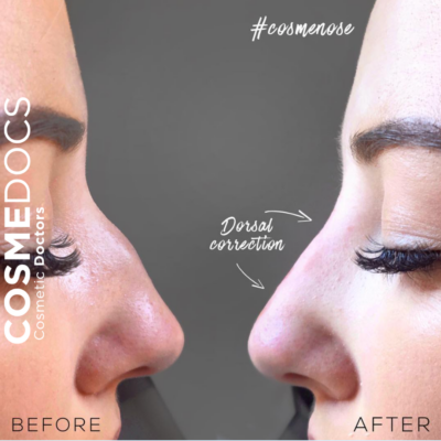 before and after images of dorsal nose correction and tip lift, showcasing the changes in nasal profile.