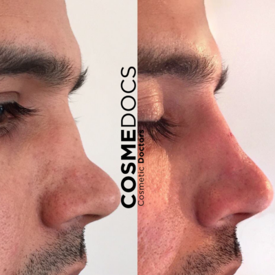 Redo of non-surgical nose job on a man post initial surgical rhinoplasty, shown in before and after photos.