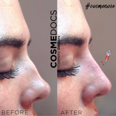 comparison of a woman’s dorsal hump before and after non-surgical nose job