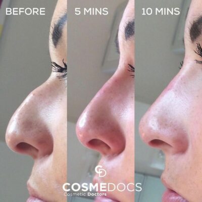 progressive stages of a non-surgical nose job, shown before, during (at 5 minutes), and after (at 10 minutes) the procedure.