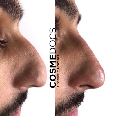 before and after image of a man’s beaked nose following a non-surgical rhinoplasty