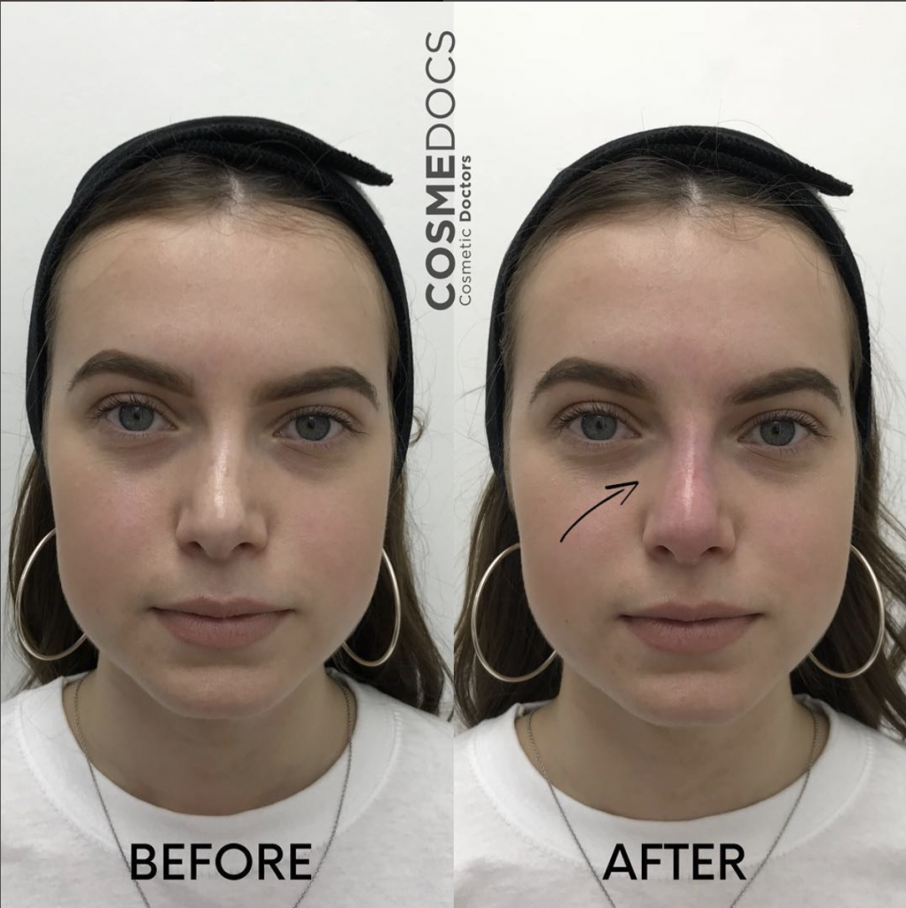 nose job before and after crooked nose