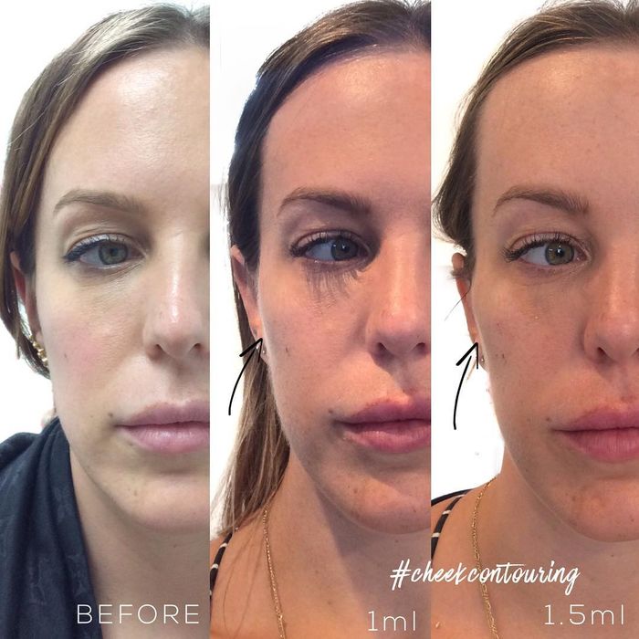 1ml Cheek Filler Before And After