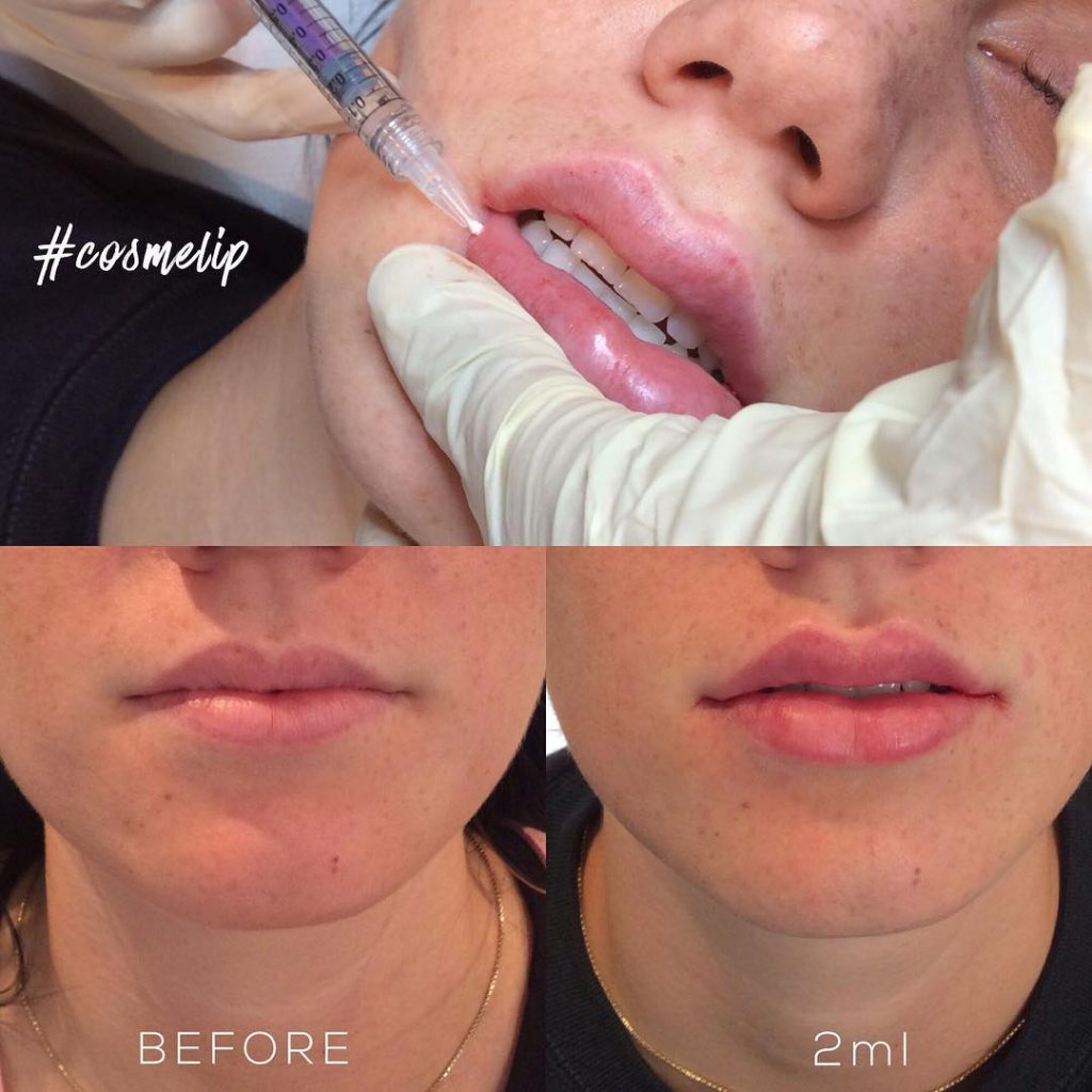 Before and after images of a 2ml lip filler procedure, showcasing the results.