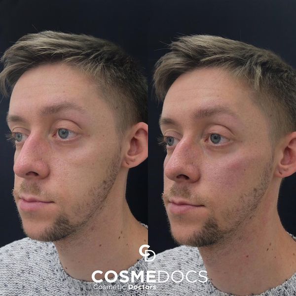cheek fillers volume loss before after