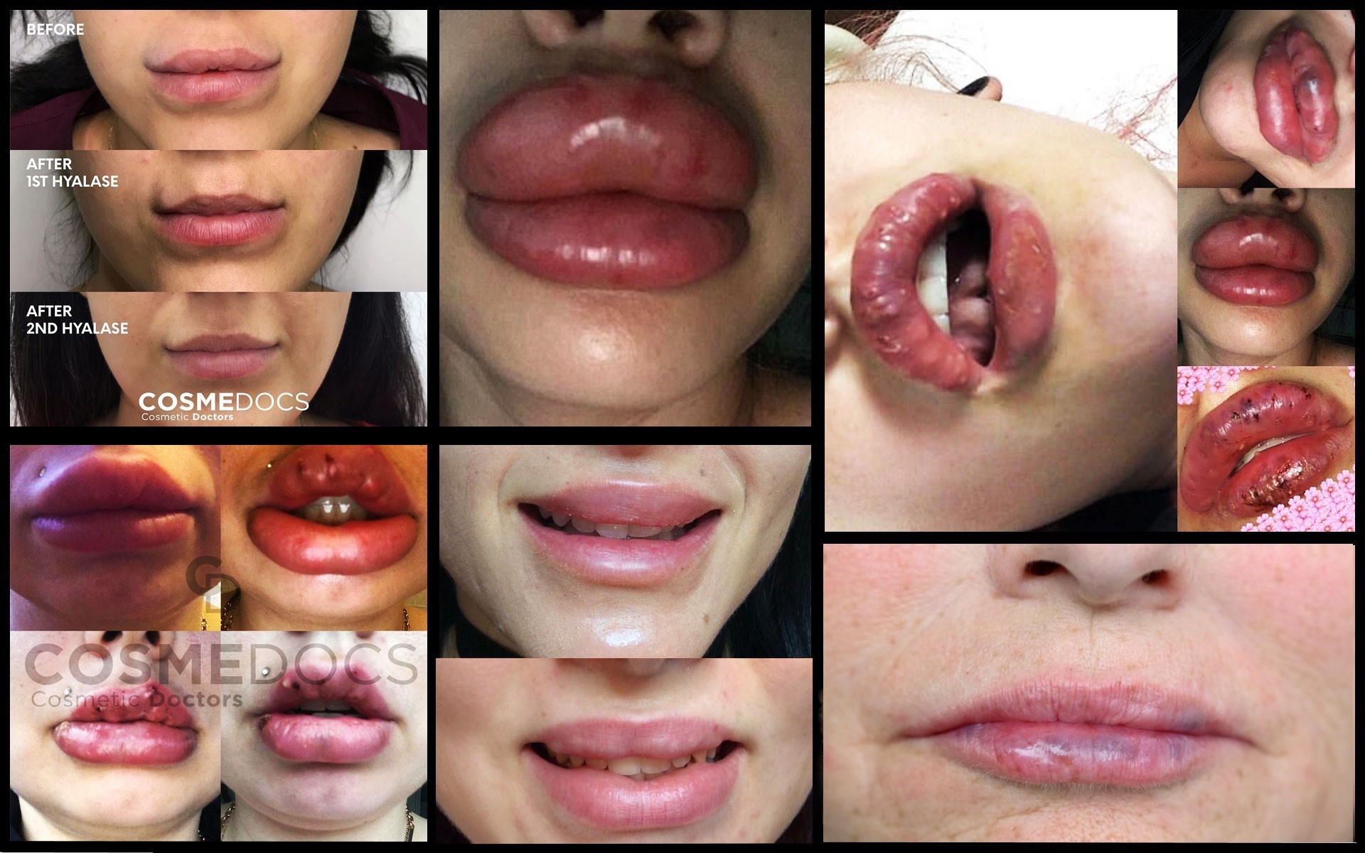 Botched Dermal Fillers Gone Wrong: Shocking Side Effect Photos