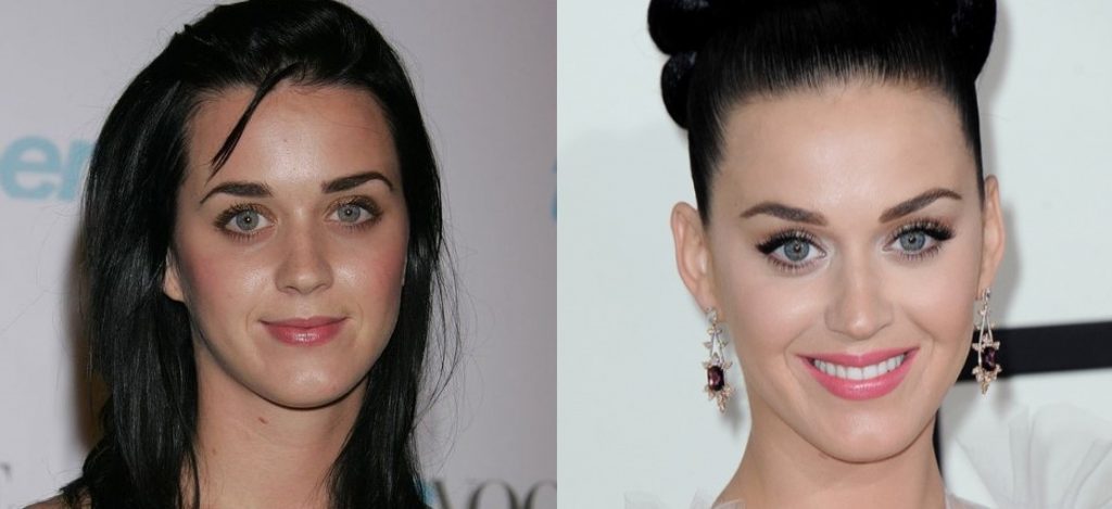 tear-trough-filler-before-and-after-katy-perry