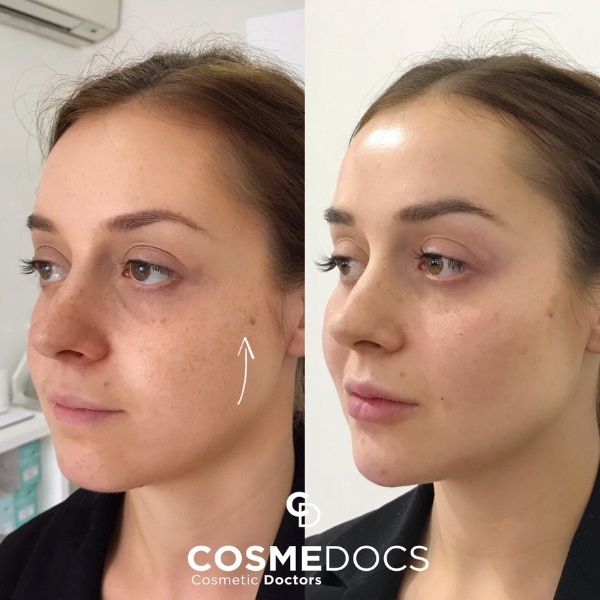 Cheek Filler Before After For Angular Facial Profile