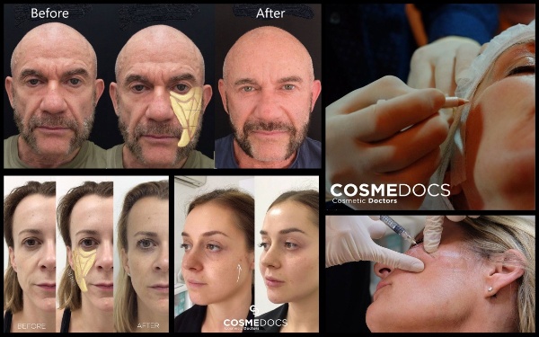 cheekbone implants men before and after