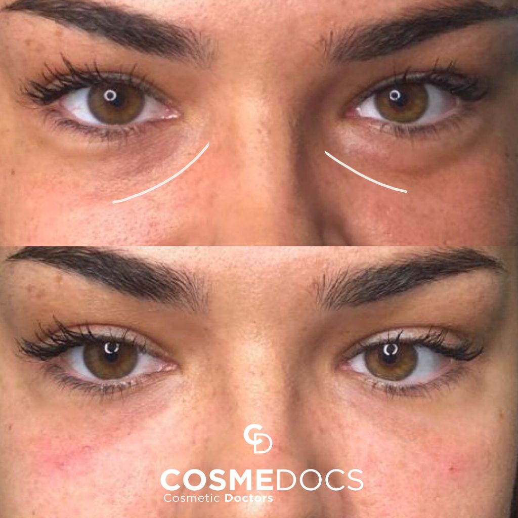 Before and After Under Eye Circles Using Dermal Fillers