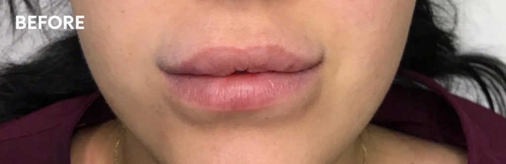 too-much-lip-fillers