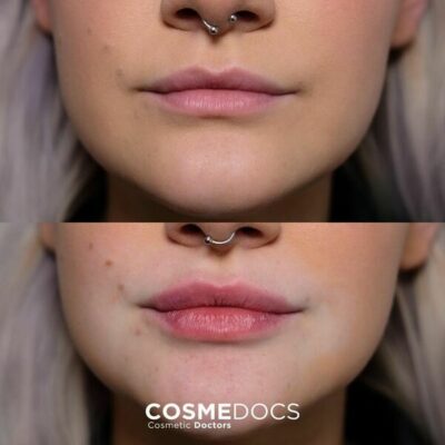 Subtle 0.5-0.75ml lip enhancement