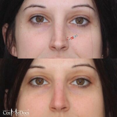 Before and after treatment of a slim nose with enhanced tip and smoothed dips