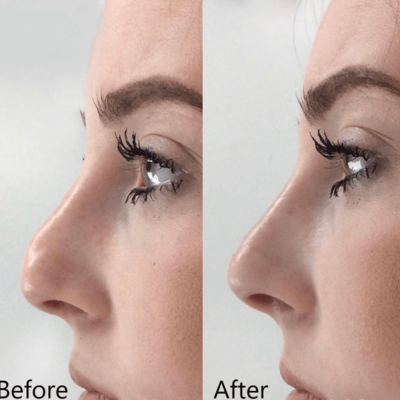 Correction of a droopy nose tip achieved through non-surgical treatment.