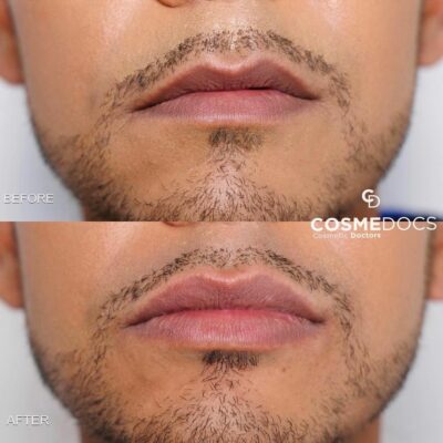 Before and after images of a male receiving 0.5ml lip enhancement, demonstrating rehydration and reduced wrinkling of the lips.