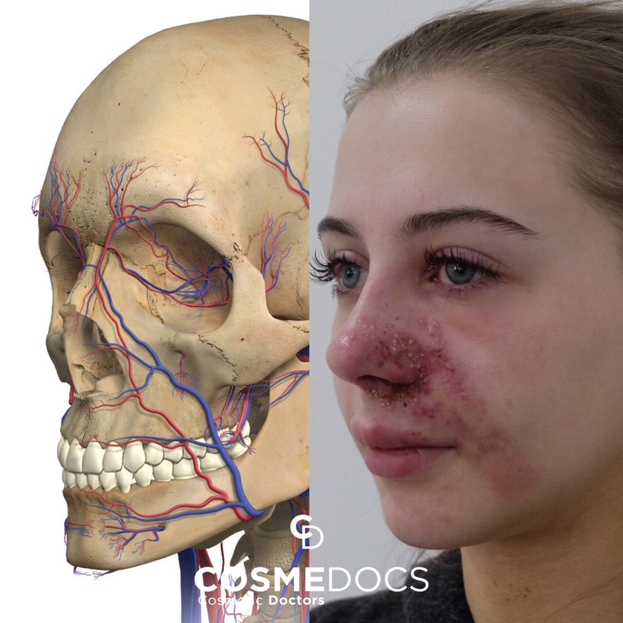 Vascular-occlusion-nose-filler-gone-wrong
