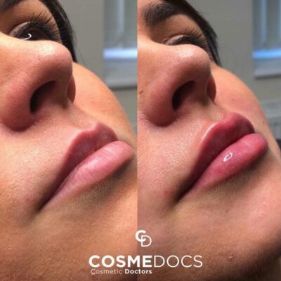 Bold but natural before after 1ml lip filler