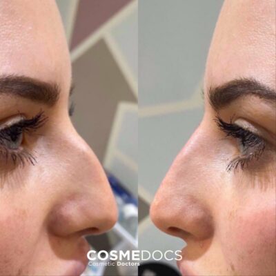 non-surgical nose job using fillers