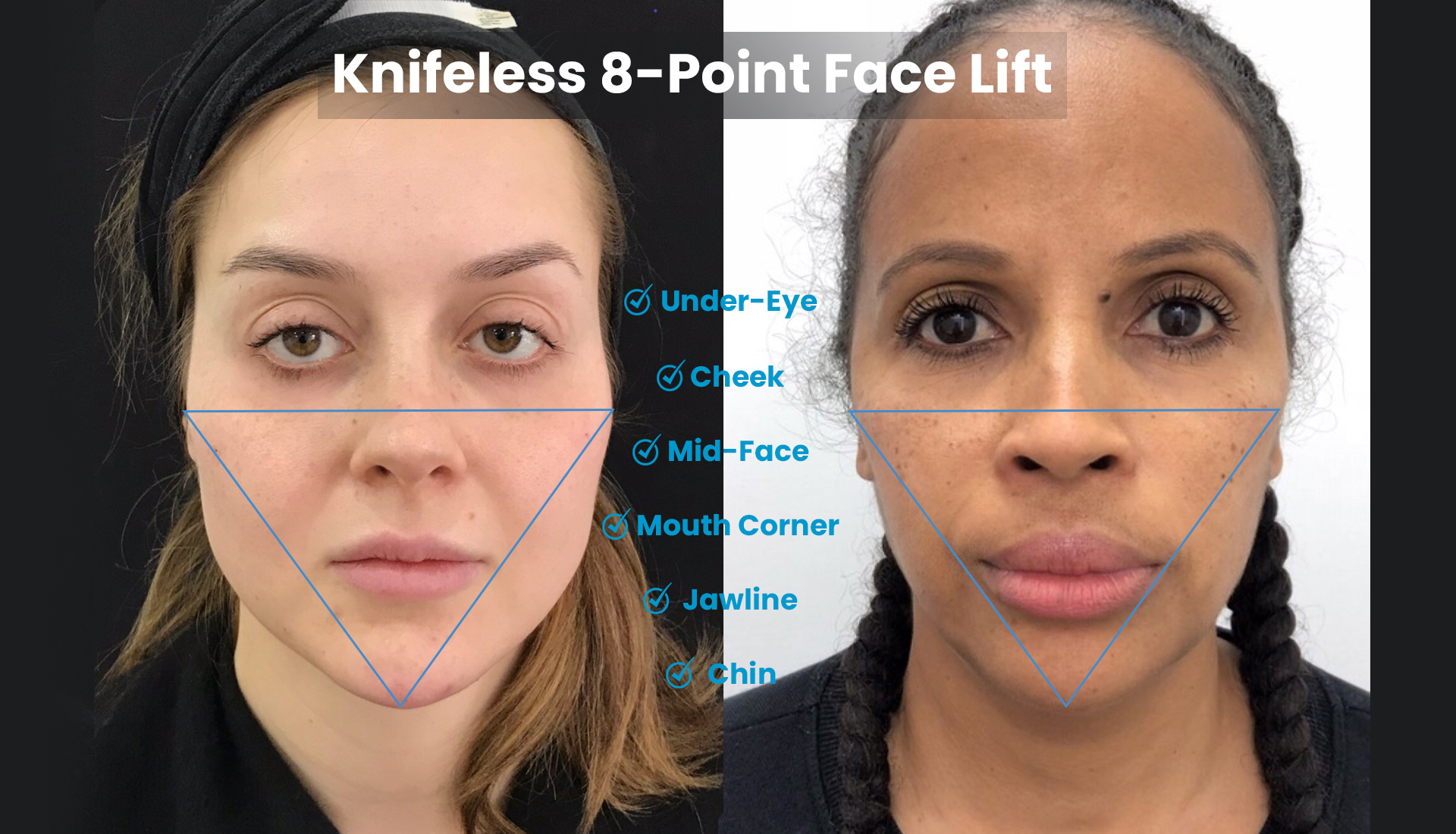 8-point-face-lift