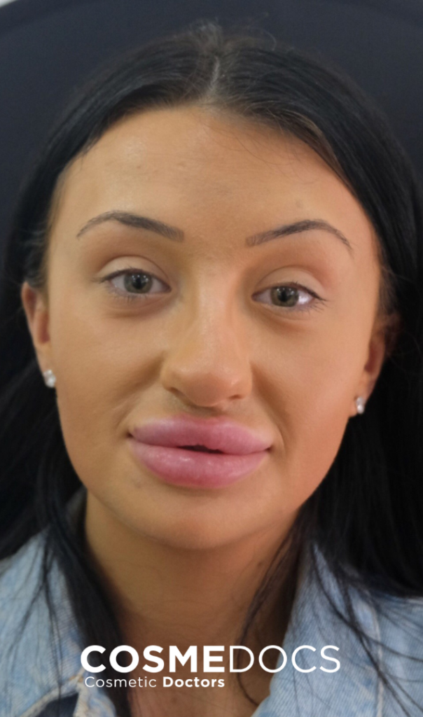 patient-nose-filler-gone-wrong