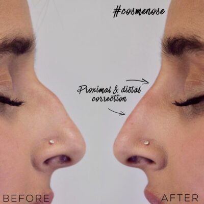 natural results after nose job with fillers