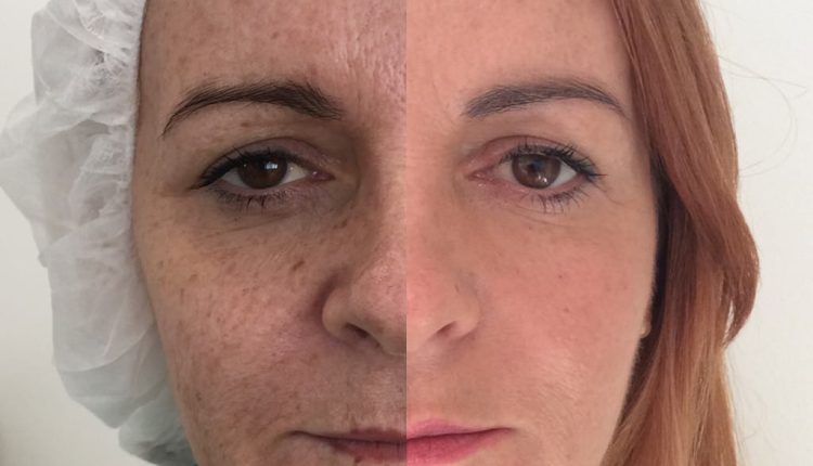 Combination  PDO Thread lift before and after combined with skin treatment