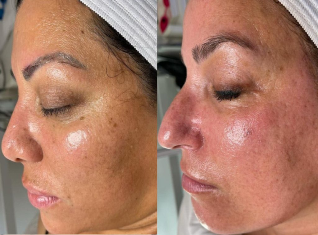 pigmentation-before-and-after