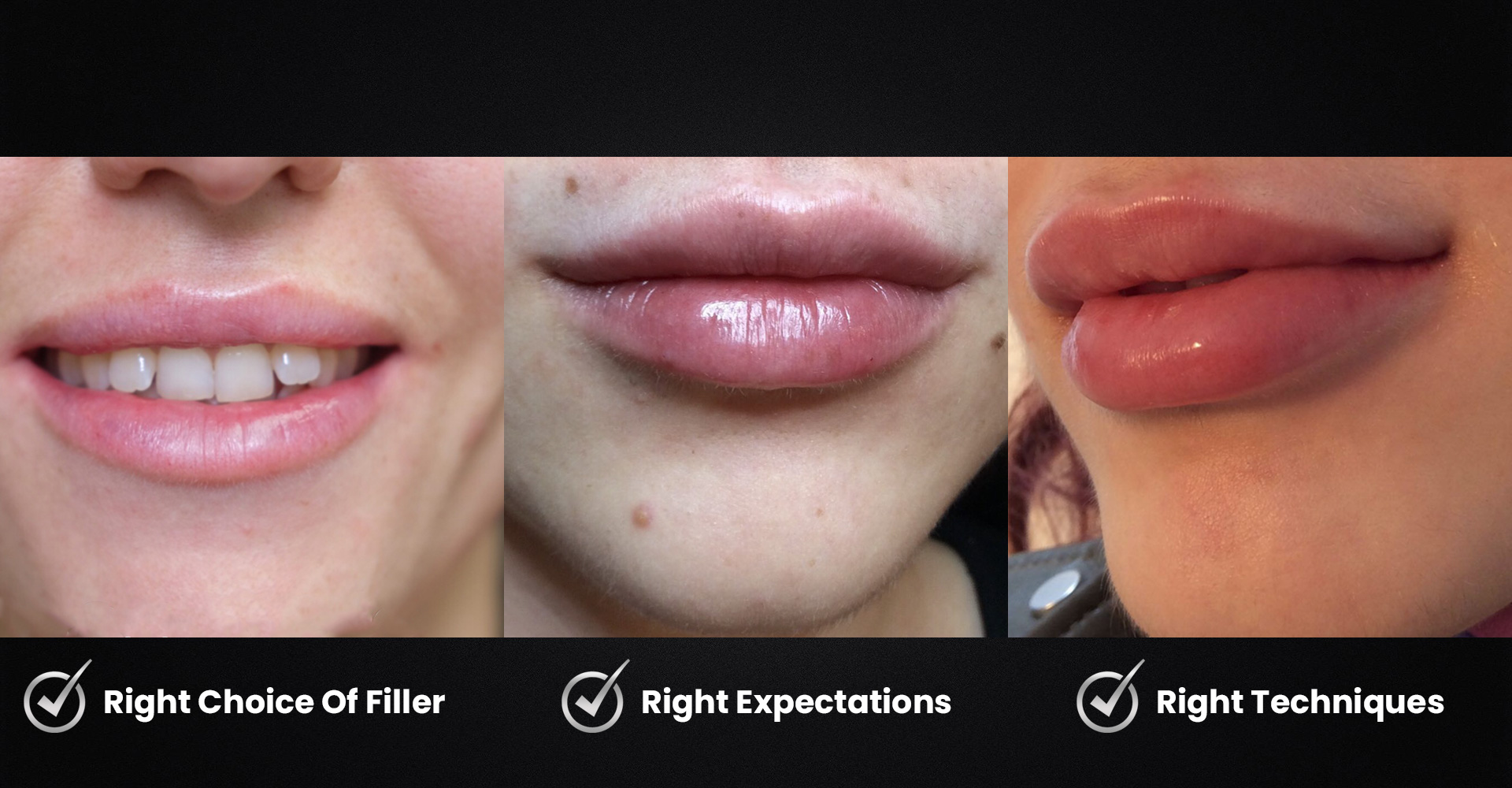 how-to-get-natural-lip-fillers