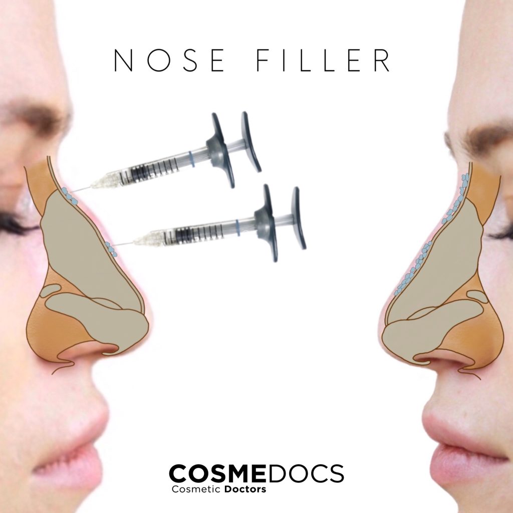 nose-filler-done-right
