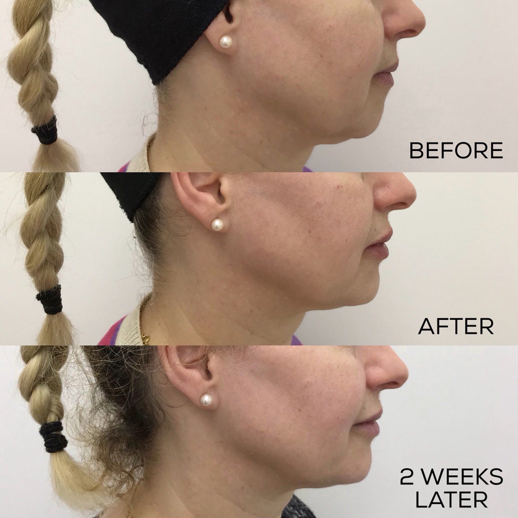 non-surgical-face-lift-before-and-after-dermal-fillers