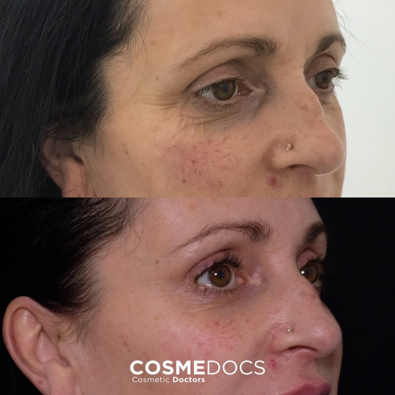 under-eye-filler-before-and-after