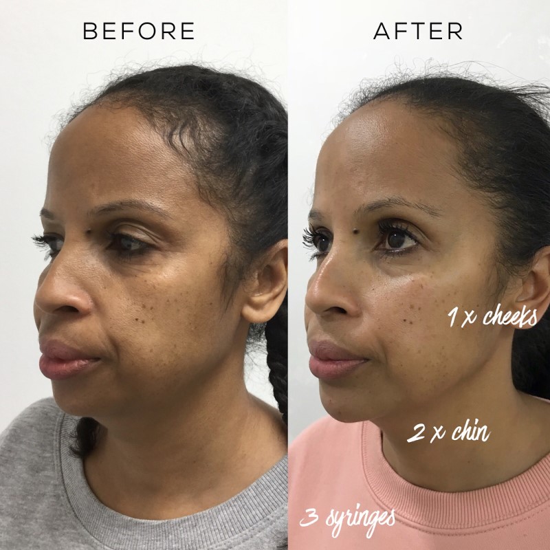 dermal-fillers-before-and-after