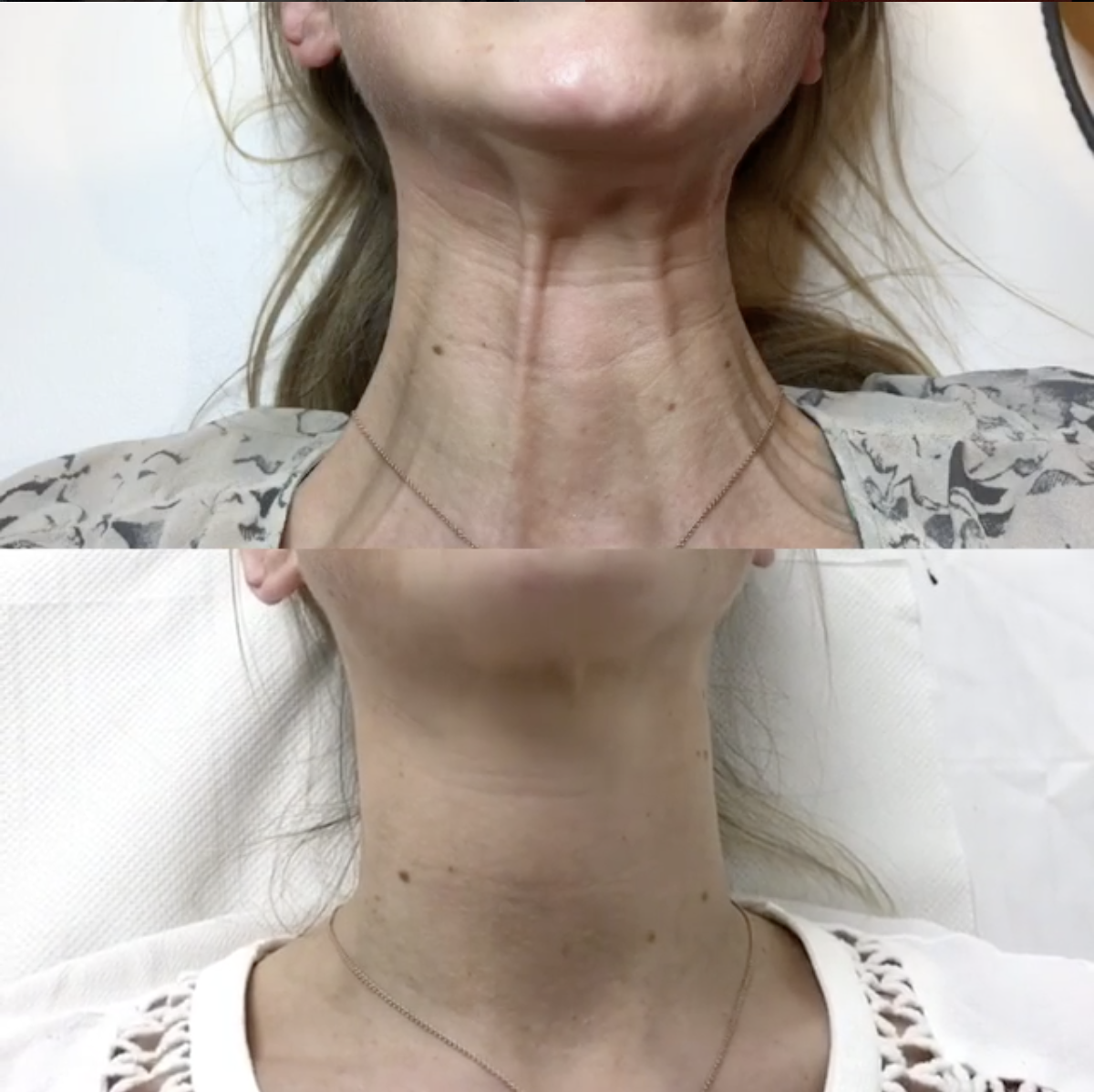 Profhilo neck band before after