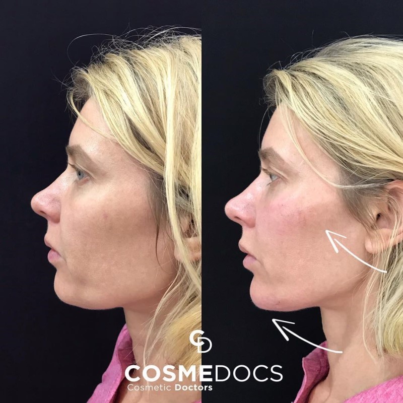 cheek-filler-before-and-after
