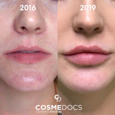 Progressive lip enhancement results over three years using 1ml lip filler treatments.