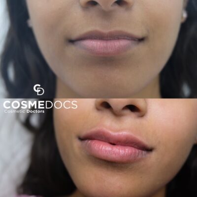 Side-by-side images showing lip enhancement from a 0.5-0.75ml lip filler treatment.