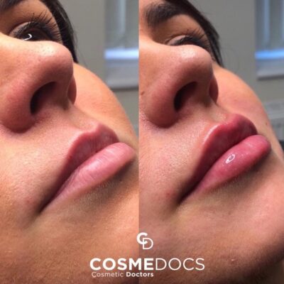 1ml lip fillers before and after pictures