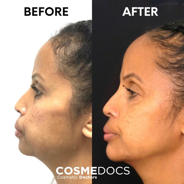 jaw and chin filler before and after
