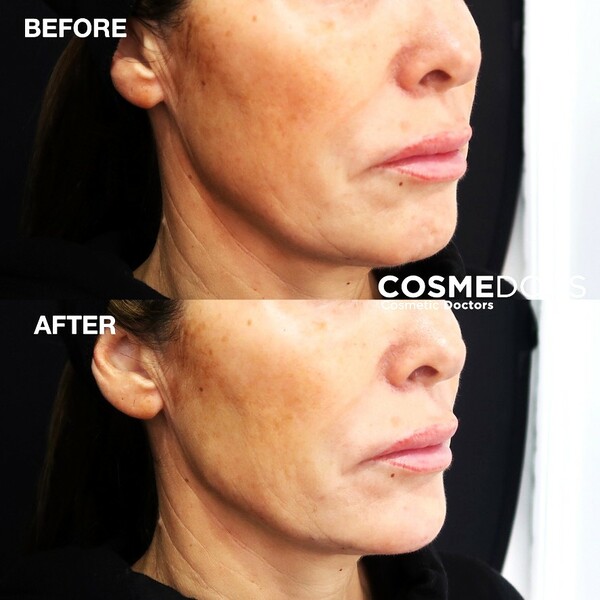 before and after chin filler