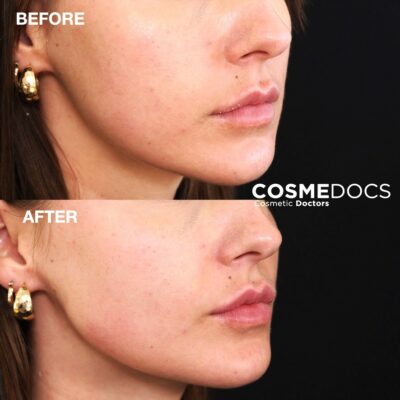 Before and after photos of combined jawline and lip filler treatment, achieving a more pronounced lower face profile.