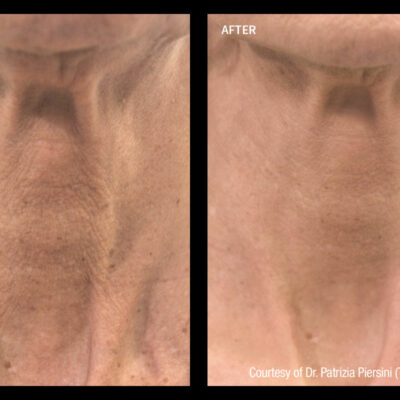 Profhilo-neck-before-after-02