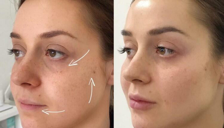 Hyaluronic Acid Make Over With Tear Trough, Lips, Chin and Jaw Filler