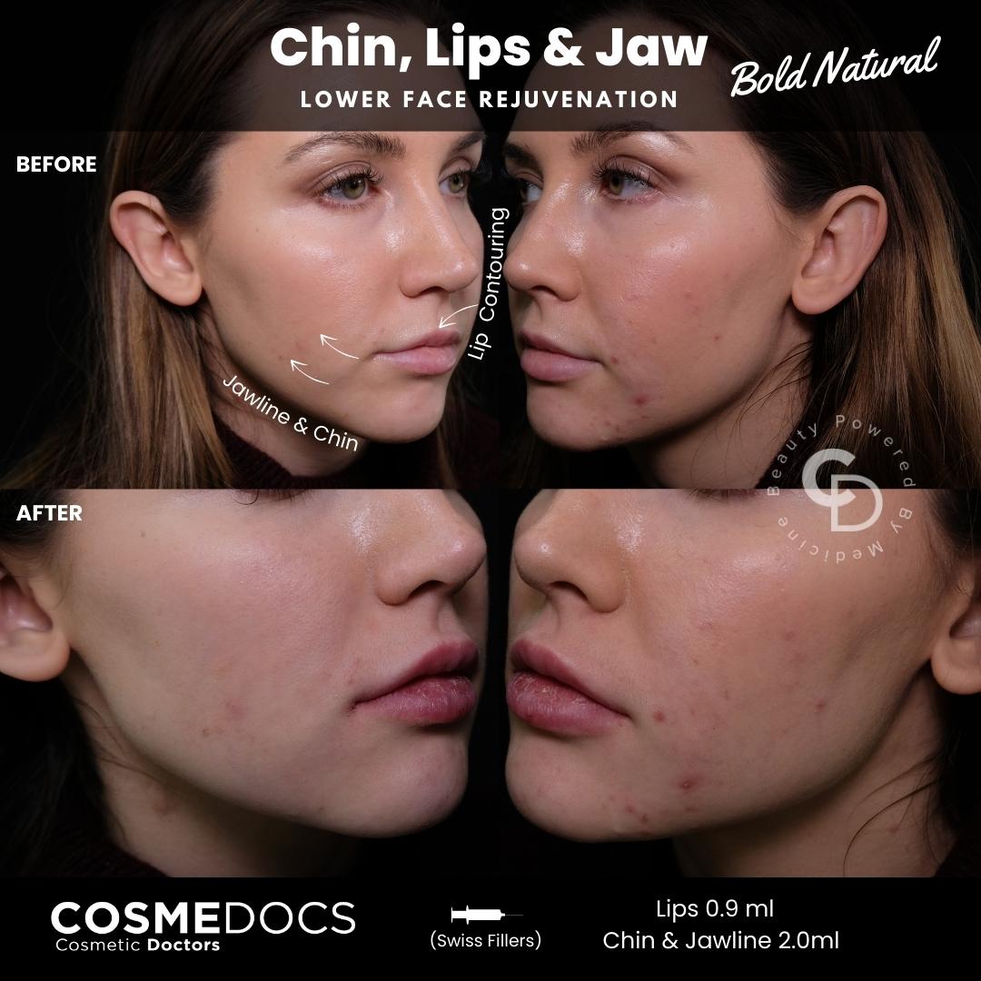 Lower face rejuvenation featuring chin, lips, and jawline fillers.