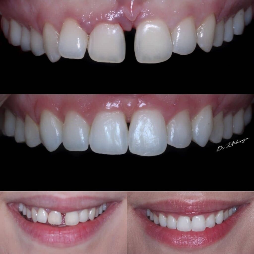dental bonding by Dr Zohaib UK