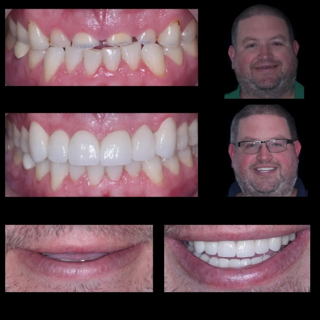 best bruxism treatment using composite resin bonding