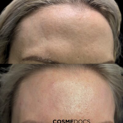 Forehead fillers before and after comparison in patient with concavity
