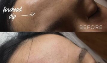 Before and after images showing the reduction of dips using forehead filler.