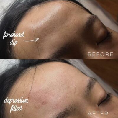 Before and after images showing the reduction of dips using forehead filler.